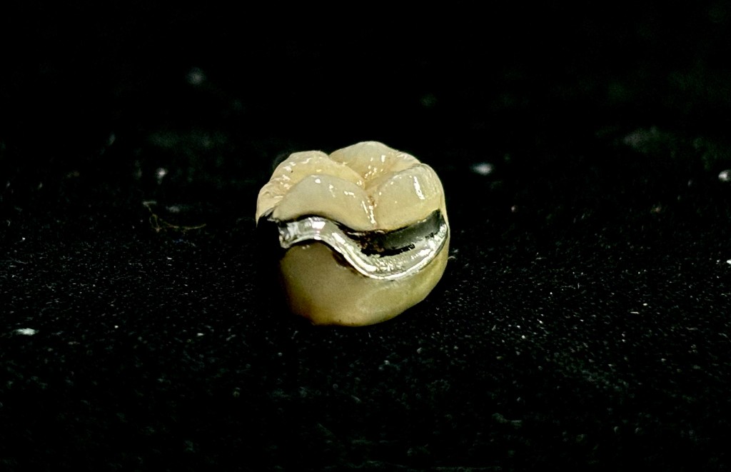 Detalle de prótesis dental