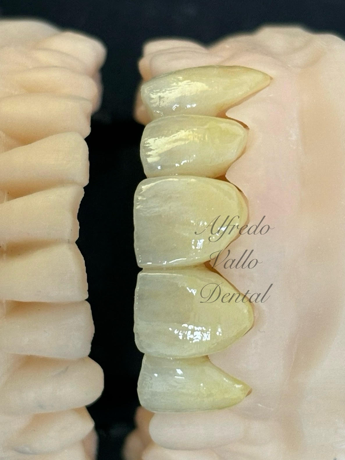Laboratorio Alfredo Vallo Dental — trabajo de prótesis
